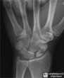 Avascular Necrosis (AVN) of the Scaphoid (Navicular)